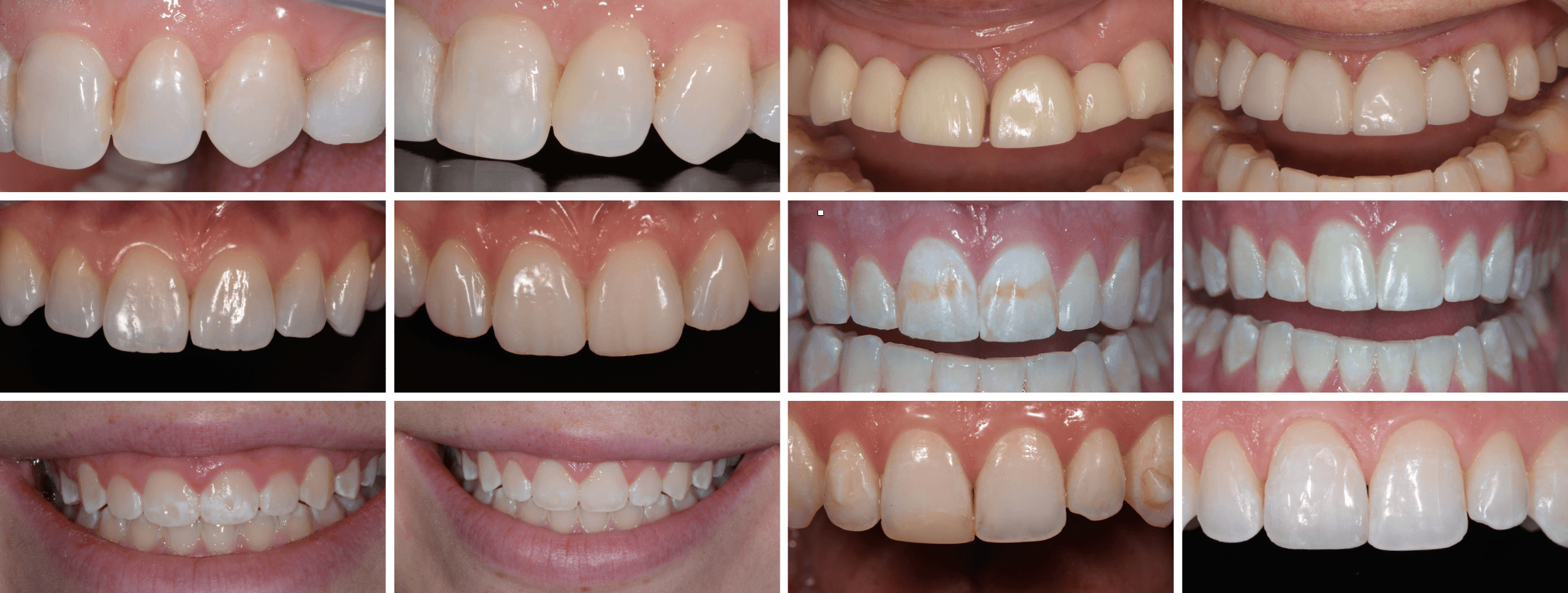 Grid of close-up photographs showing natural teeth and anterior restorations.